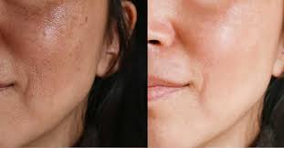 Melasma