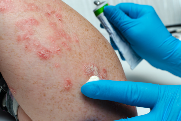 Psoriasis Treatment