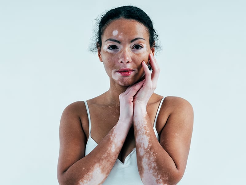 Pigmentation Disorders